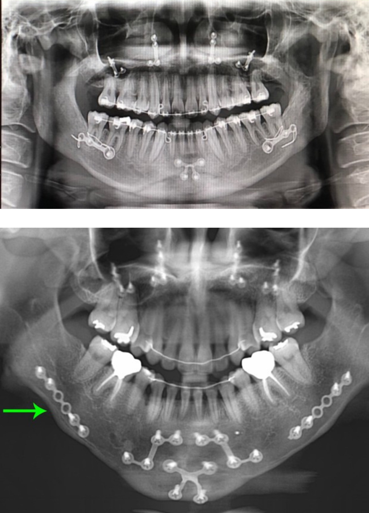 미용성형이 아닌데 한때 열풍처럼 유행했던 수술.gif | 인스티즈