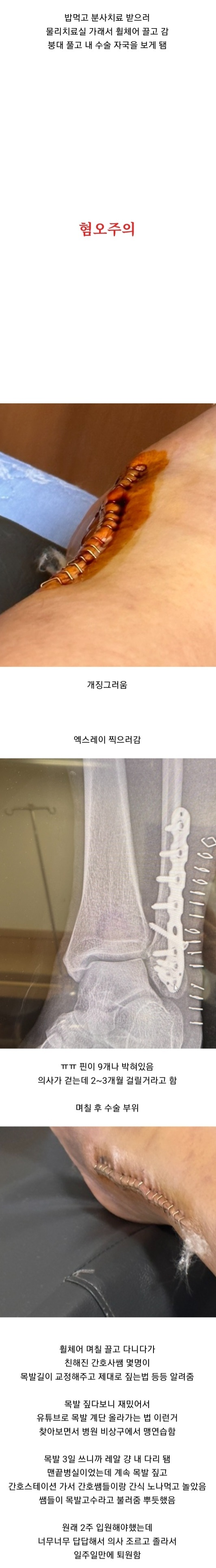 약혐주의) 어느 건강하고 회복력 아주 좋은 쾌녀의 발목뼈 부러진 후기 | 인스티즈