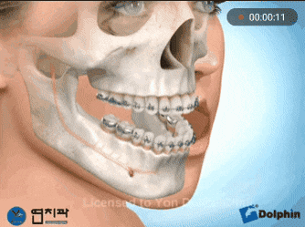 미용성형이 아닌데 한때 열풍처럼 유행했던 수술.gif | 인스티즈