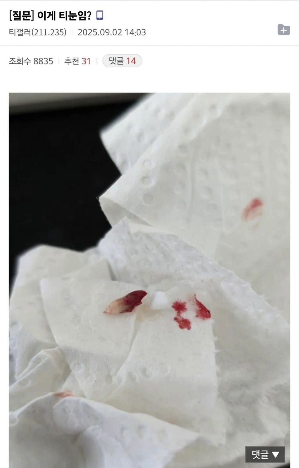 이게 티눈임? | 인스티즈