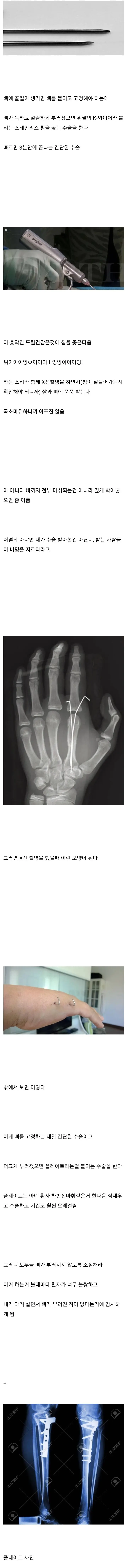 뼈 안부러져본 사람들이 의외로 모르는 사실들.jpg | 인스티즈