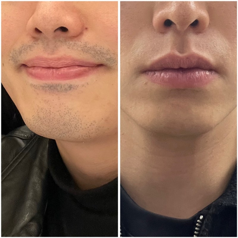 수염 레이저 제모.gif | 인스티즈