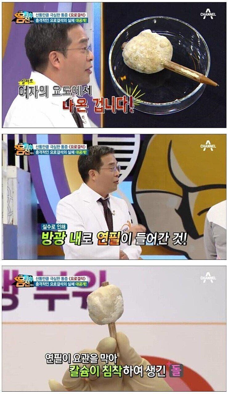요로결석 레전드 | 인스티즈