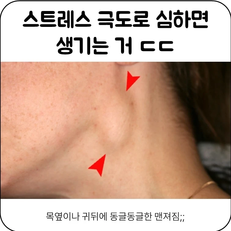 스트레스 극도로 심하면 생기는거 | 인스티즈