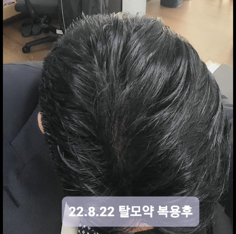 어느 한 남자의 탈모약 후기 | 인스티즈