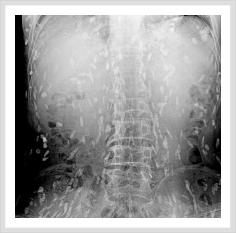 (혐오주의) 생선회 먹고 기생충이 온몸에 퍼진 남성 | 인스티즈