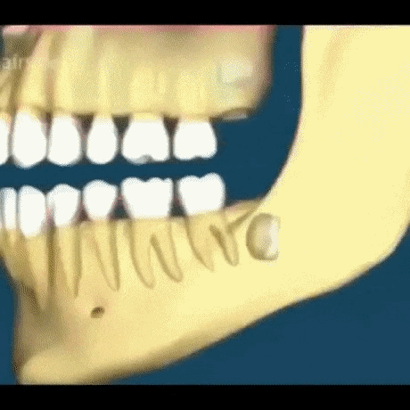 매복사랑니 피해유형 | 인스티즈