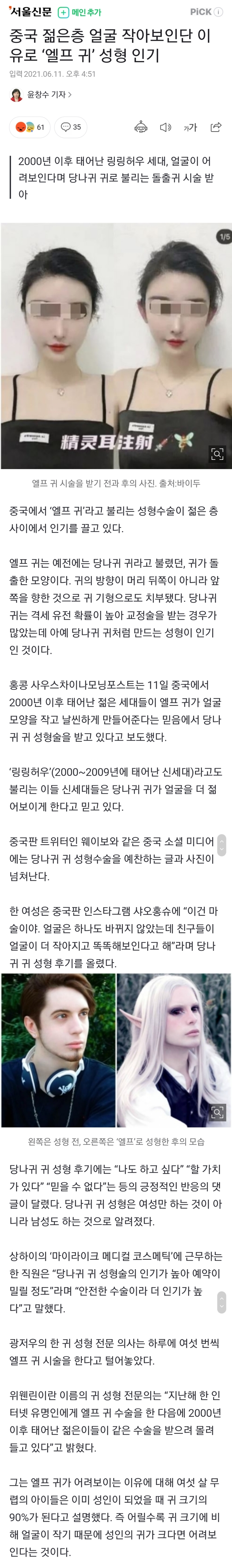 중국 젊은층 얼굴 작아보인단 이유로 '엘프 귀' 성형 인기 | 인스티즈