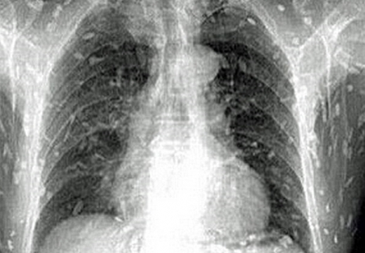(혐오주의) 생선회 먹고 기생충이 온몸에 퍼진 남성 | 인스티즈