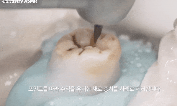 이빨 닦을때 놓치는 부위 top 5 .JPG | 인스티즈