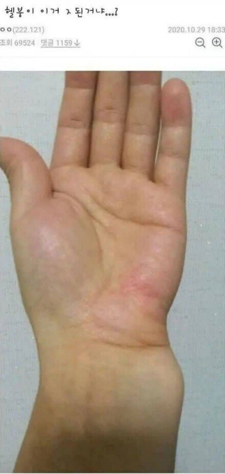 의사가 바라본 손목 브레이커.jpg | 인스티즈