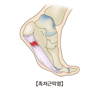 족저 근막염