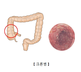 크론 병
