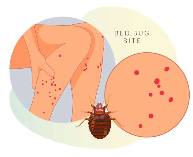 빈대 물린 자국 이미지
