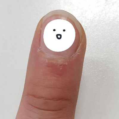 손톱찡