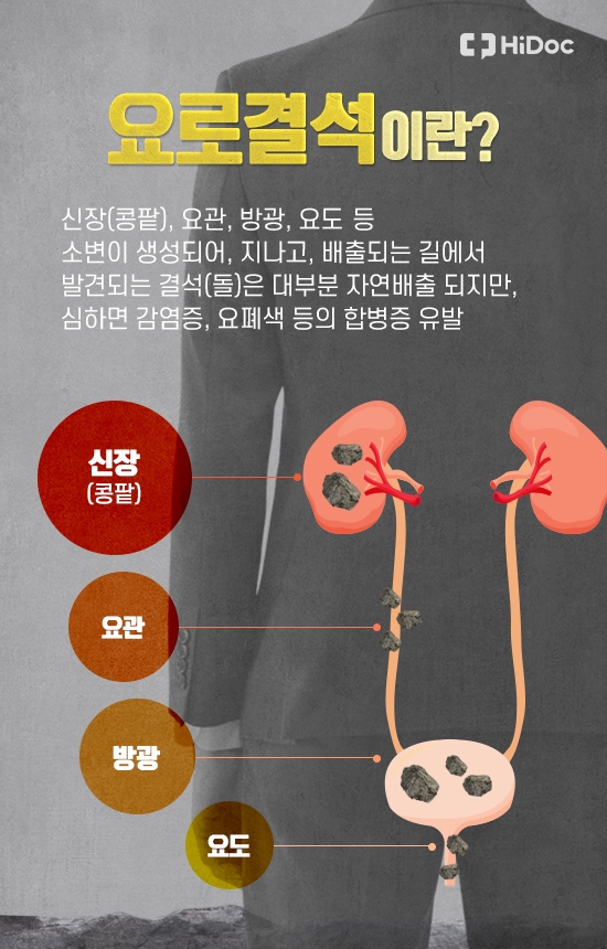 물을 잘 안 마셨더니.. 사람 잡는 요로결석