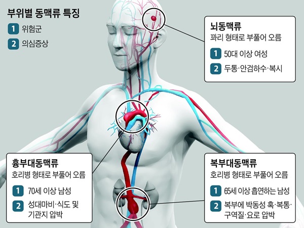 뇌동맥류는 두통·복시, 복부는 박동성 혹 만져지면 의심 뇌동맥류는 두통·복시, 복부는 박동성 혹 만져지면 의심