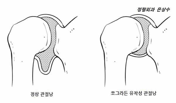 <사진1>오십견 상태를 나타내는 그림 /사진-은상수 전문의 제공