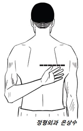 <사진4>열중쉬엇 자세로 엄지손가락의 높이가 어느정도 인지 건강한 팔과 비교해 본다. /사진-은상수 전문의 제공