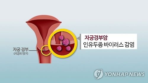 자궁경부암(CG) [연합뉴스TV 캡처]