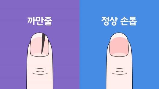 손톱 검은세로줄 흑종 혹은 곰보를 주의해야 하는 이유 5