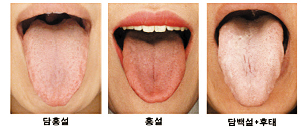 정상 혀, 정상 혀보다 붉은 홍설, 정상 혀보다 옅은 담백설/한국한의학연구원 제공