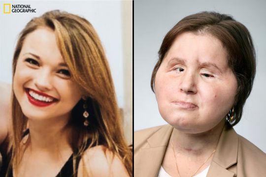 사진 왼쪽은 사고가 있기 전, 오른쪽은 안면이식수술 후 최근 근황(사진=내셔널지오그래픽)