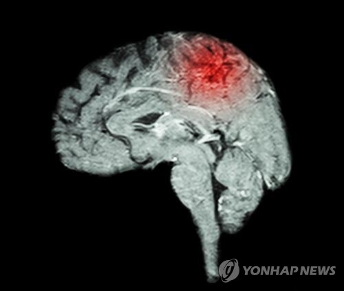 뇌졸중 [게티이미지뱅크 제공]