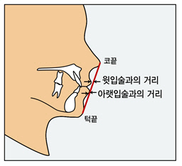 돌출입 자가진단법, 코끝과 턱 끝을 연결한 선에서 윗입술과 아랫입술 간의 거리를 잰다. 평균적으로 윗입술이 선에서 약 2mm 나오고 아랫입술은 선에 닿는다. 그러나 이보다 더 후방에 위치해야 심미적인 입술 위치로 여겨진다.