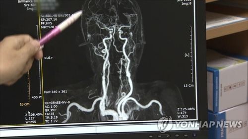 뇌혈관 [연합뉴스TV 제공]