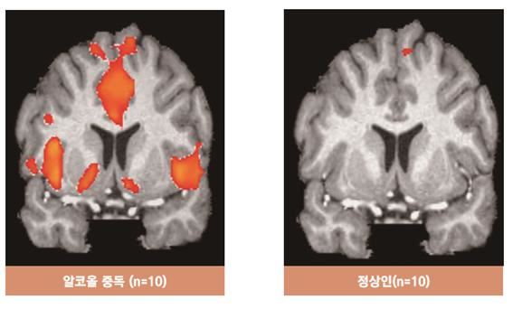 알코올중독자가 술 관련 사진을 보았을 때 대뇌 반응 : 술과 관련된 사진을 보여주었을 때, 오른쪽의 사진과 같이 정상인의 뇌는 아무런 변화가 없지만, 왼쪽에 있는 알코올 중독자의 뇌는 보상회로가 강하게 반응한다. 자료 : 중독포럼 제공
