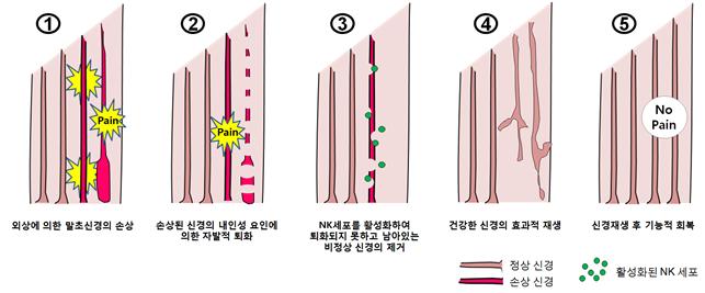 ① 당뇨, 외상, 항암제 등으로 말초신경이 손상되면 ②손상된 신경은 저절로 퇴화된다. ③미처 제거되지 못한 손상된 신경은 자연살해세포가 활성화돼 제거한다. ④이를 통해 신경의 재생이 일어나며 ⑤만성적 통증으로부터 회복된다. -사진 제공 서울대