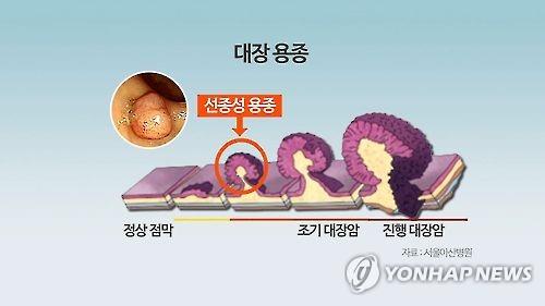 대장 용종 [연합뉴스 자료사진]