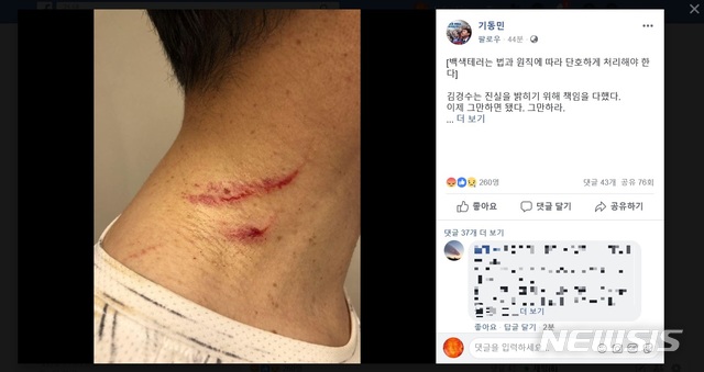 【서울=뉴시스】기동민 더불어민주당 의원이 자신의 페이스북에 올린 김경수 경남지사의 상처 사진. (사진 = 기동민 의원 페이스북 캡쳐) 2018.08.10. photo@newsis.com