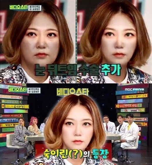 김숙피부 이미지