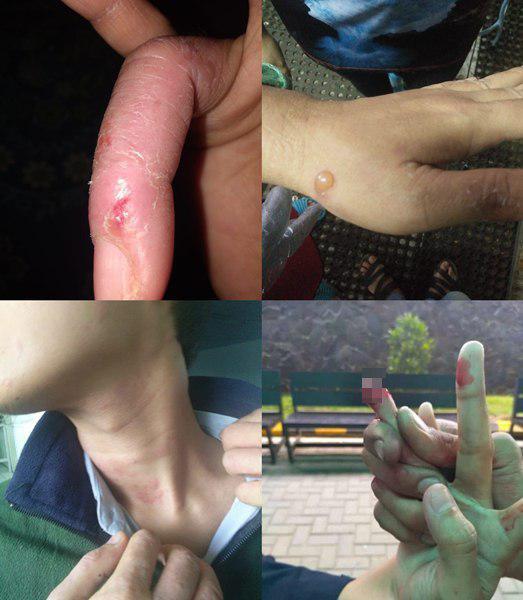 삼성전자 하청 공장인 롱빈 노동자들이 각종 화학약품에 노출되어 몸에 수포와 두드러기가 생겼다. 이 공장에서는 삼성이 사용을 제한한 톨루엔이 사용됐다. 작업 중에 손가락이 잘린 노동자도 있었다. 수카부미(인도네시아)/산재 피해 노동자들 제공