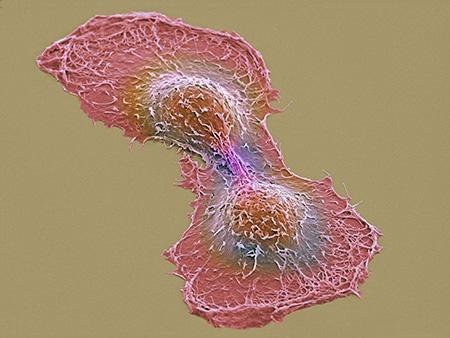 암세포 두 개의 전자현미경 영상 이미지 [ UCSD NCMIR 토마스 데링크 제공]