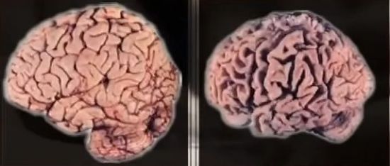 정상인의 뇌(왼쪽)와 알콜 중독자의 뇌. 알콜중독자의 뇌는 정상인에 비해 30%나 줄어 들었습니다. 알코올이 뇌를 녹인 결과라고 할 수 있습니다. [사진=유튜브 화면캡처]
