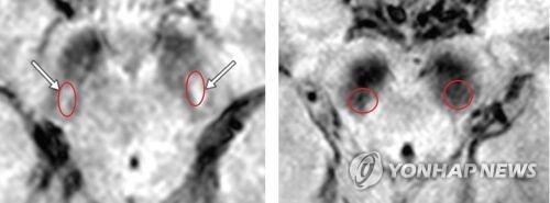 렘수면행동장애 환자의 뇌 MRI 영상. 오른쪽은 파킨슨병이 예상되는 경우. [연합뉴스 자료사진]