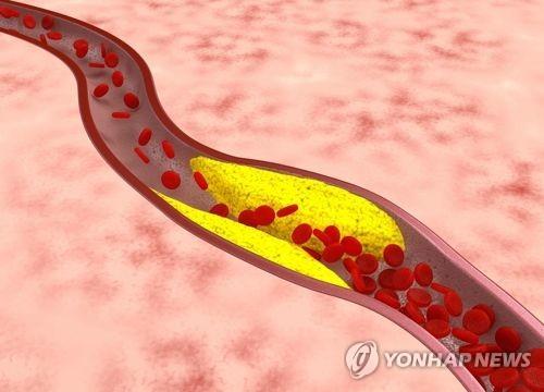 혈관 콜레스테롤 [게티이미지뱅크 제공]