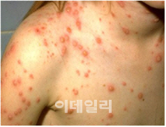 몸에 발진이 생긴 수두 환자의 모습(사진=질병관리본부 제공)
