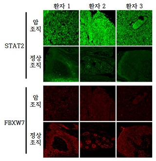 흑색종 환자에서 FBXW7과 STAT2 단백질의 양적 비교각각 같은 환자의 흑색종 조직과 흑색종 주변 정상조직에서 FBXW7과 STAT2 단백질의 양적 차이를 검증한 결과 암조직과 정상조직에서 FBXW7과 STAT2 단백질 양이 서로 반대의 상관관계가 있음을 보여주고 있다/사진=한국연구재단