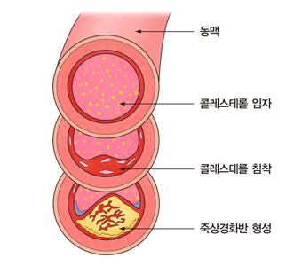 죽상경화 [서울아산병원 제공]