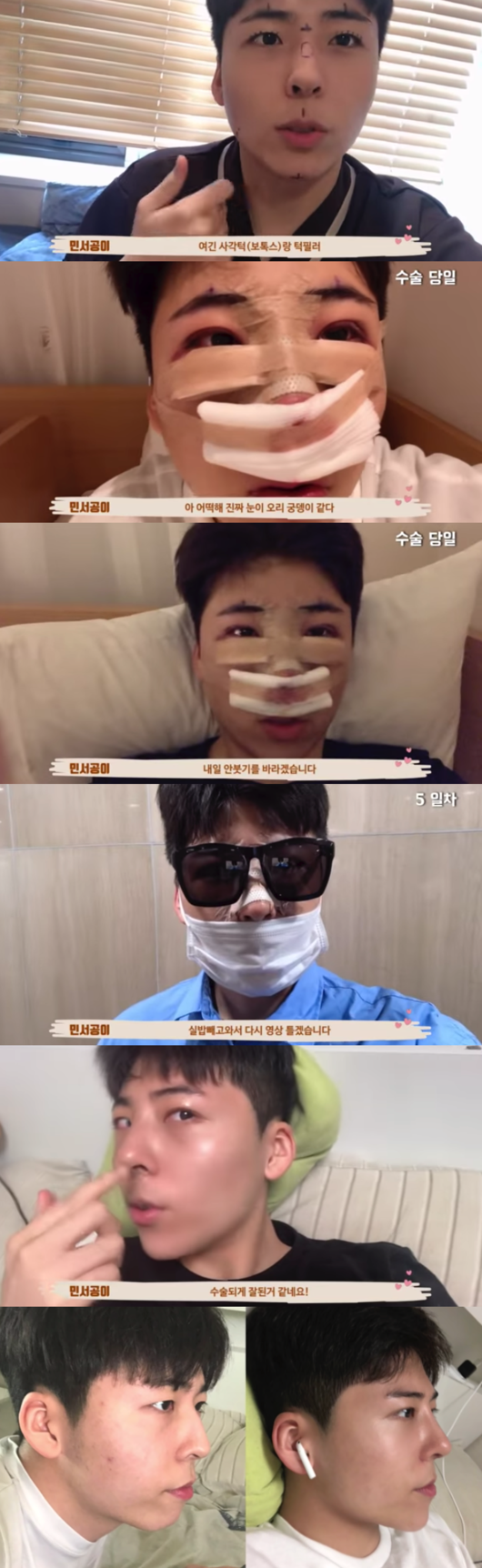 Kim Min-seo, who appeared on the show as Park Bo-gum Similiar, performed plastic surgery.Kim Min-seo posted a video titled Eye correction, Very Rico corrected! Plastic V log! on his YouTube channel.In the video, he said that he was not recommending surgery, but he was talking about the information, and he was consulted and paid by plastic surgeons.Kim Min-seo underwent eye correction and Very Rico surgery on the advice of the Moldmanleb Youtuber Young-Yearple; he was consulted seriously by a specialist, saying his eyes looked blurry.I decided to get a fat relocation under the eyes in the jaw filler, and the swelling immediately after the surgery was revealed.From the day of surgery, he recorded the video from the moment he pulled the stitches and played with fans, Gong Yoo. He also ate pumpkin juice, saying extracting the middle swelling.The moment of disinfection of the wound and the process of removing the cotton and splints are being released as a video and collecting hot topics.Im getting a little bit of a chin line, because I got a jaw filler. Im still bruised, but Ill play the video on the 14th.Very Rico was a complex, but the line became natural. Kim Min-seo, who was born in 2002, made headlines on KBS Joys Ask Anything broadcast in May, complaining that he is suffering from Park Bo-gum Similiar unintentionally.People have been struggling to spread photos on SNS.However, after the broadcast, some netizens ridicule and evil continued, Kim Min-seo explained, I was not in good shape the other day, so I was not swelling my face and was not in a hurry.He also added, I sue all the evil!image capture
