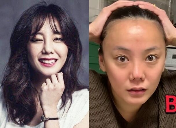 탈모로 모발 이식 상담 받고 왔다는 여배우 | 키노라이츠 탈모로 모발 이식 상담 받고 왔다는 여배우 | 키노라이츠