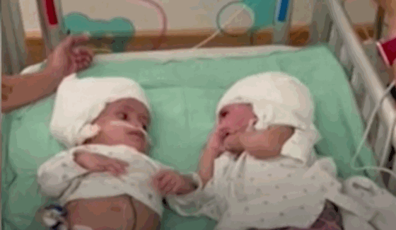 쌍둥이 자매. 12시간에 걸쳐 머리를 분리하는 수술을 했다.