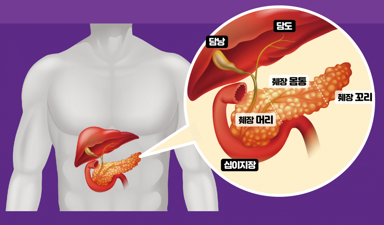 조기발견 시 높아지는 췌장암 생존율, 검사는 어떻게? 조기발견 시 높아지는 췌장암 생존율, 검사는 어떻게?
