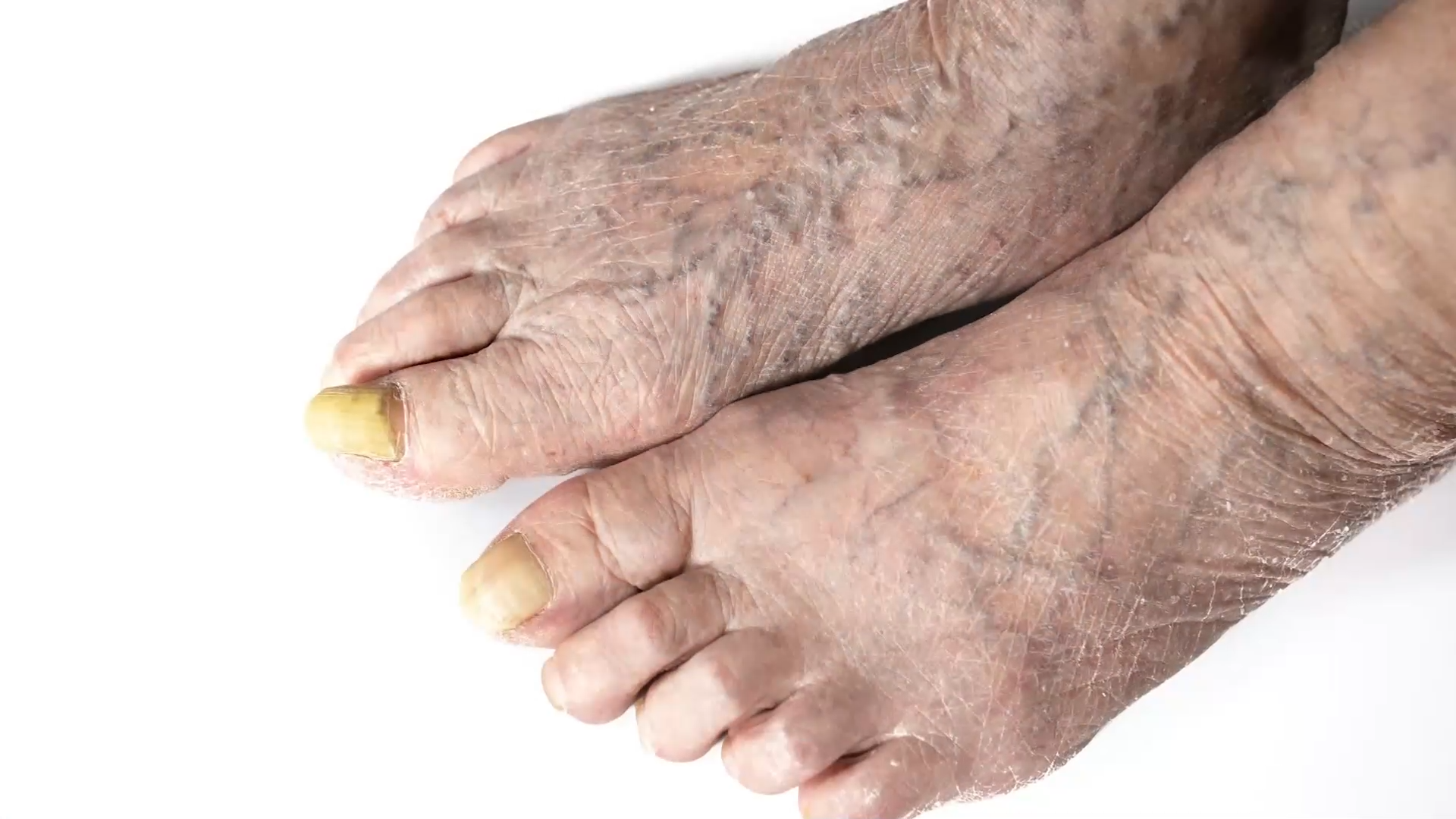 발 가려움 지속! 무좀이 아닌 '이것'을 의심해라? | 1일 1짤 발 가려움 지속! 무좀이 아닌 '이것'을 의심해라? | 1일 1짤