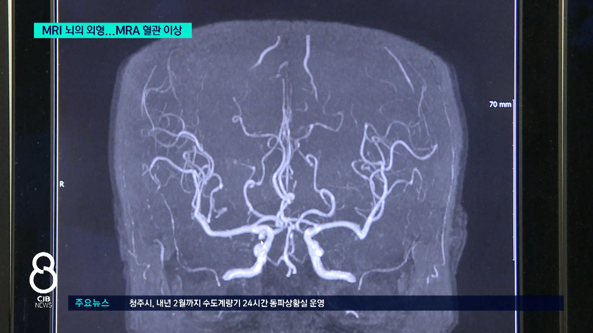 건강검진에서 mri 받을까 mra 받을까 차이는