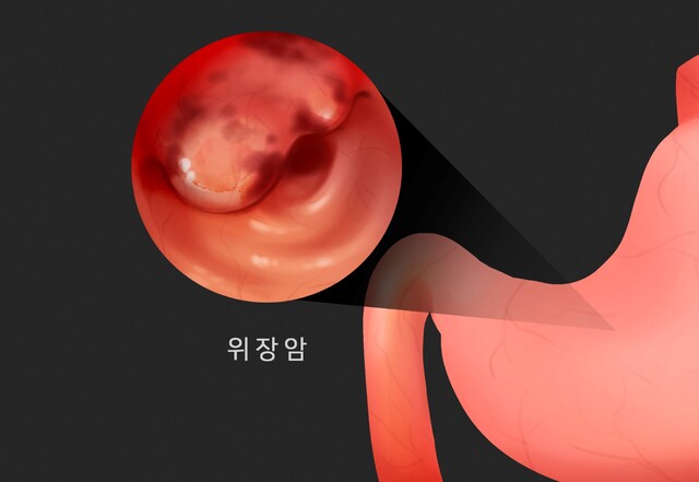 65세 이상 남성, 위암 발견시 ‘이것’ 주의